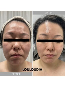 ルルーディア(LOULOUDIA)/小顔矯正によるリフトアップ術♪