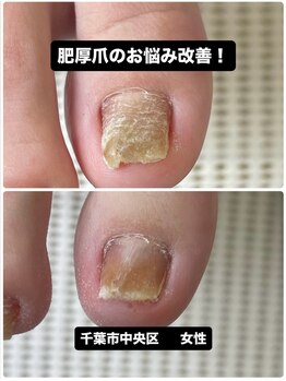 巻き爪じゅん 船橋店/肥厚爪による見た目の悩みを解決