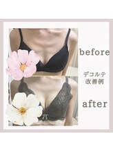 アリサナ(Arisana)/症例写真　バスト　葛西