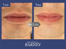 バーニー 梅田店(BARNEY)/ヒゲ脱毛の経過/脱毛/顔脱毛