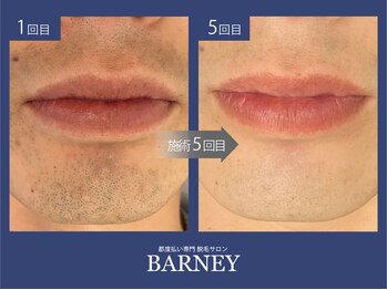 バーニー 梅田店(BARNEY)/ヒゲ脱毛の経過/脱毛/顔脱毛