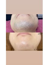 ソルツーサロン マナ(MANA)/メンズ髭脱毛［葛飾区・四つ木］