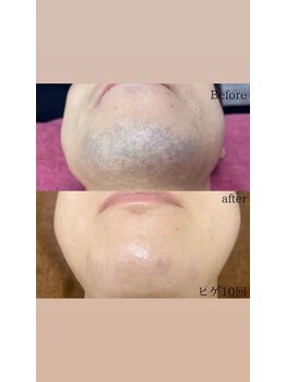 ソルツーサロン マナ(MANA)/メンズ髭脱毛［葛飾区・四つ木］