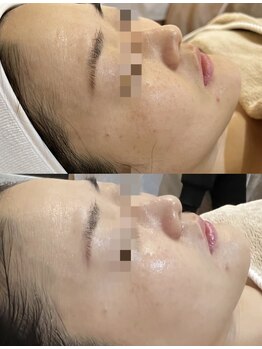 ナラビューティー(NARA BEAUTY)/韓国肌管理!ララピール