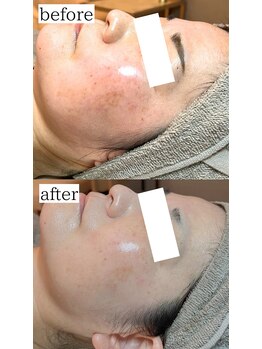 フィエルテ(Fielte)/肌質改善/ピーリング/小顔