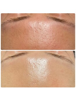 アンヘル(Angel)/赤みもレストセルトリートメント