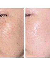 リッチアンビューティー(Rich.an beauty)/Eライト☆理想の肌へ