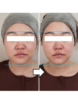 きしの美容整体院/フェイシャルリフトケアBA