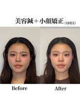 鍼グリッター 岡山本院(鍼Glitter.)/小顔矯正×美容鍼