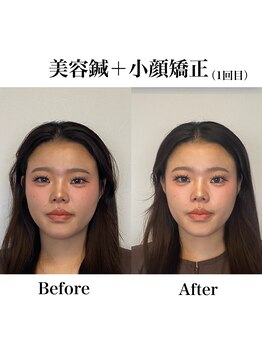 鍼グリッター 岡山本院(鍼Glitter.)/小顔矯正×美容鍼