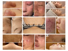 ボウ 名古屋店(VOEUX)/皮膚科学に基づくビタミンAケア