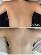 月とルーツ 大阪南堀江(月とroots)/背中ニキビ・跡・ざらつき・毛穴