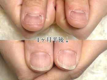 グラシナ 鳥丸店/(深爪/長さだし/フィルイン/)