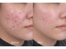 サロンド テン 広尾(salon de TEN)/広尾ハーブピーリング