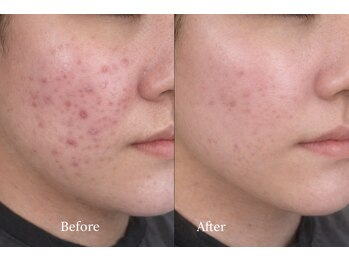 サロンド テン 広尾(salon de TEN)/広尾ハーブピーリング