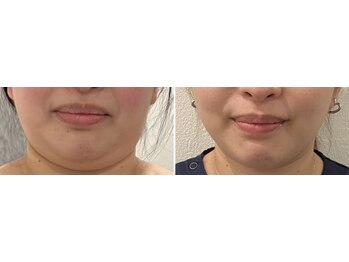 ジョイビー 新宿本店(JoyBee)/【レモンボトル】症例写真