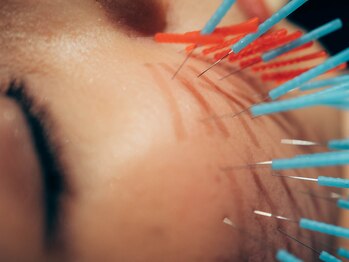 くすの樹接骨院 整体院 多 布施院/[美容鍼/鍼灸]リフトアップ/小顔