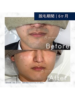 メンズクリア 藤沢OPA店/【メンズクリア】お客様の施術例