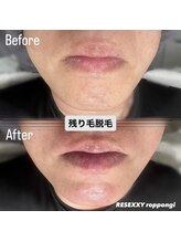 リゼクシー INTERNATIONAL麻布十番 六本木(RESEXXY)/残り毛脱毛