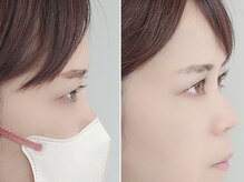 スキン 心斎橋店(skin)/一重/重い奥二重の方にも★