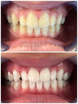 グロウ 東区香椎(GLOW)/ホワイトニングビフォーアフター