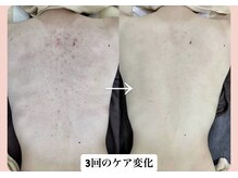 スキンハピネス(skinhappiness)/背中ハーブピーリングケア