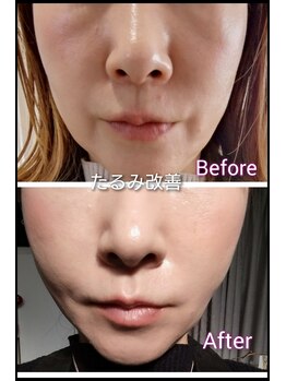 エタニティ(Eternity)/結果重視!!たるみ・小顔効果