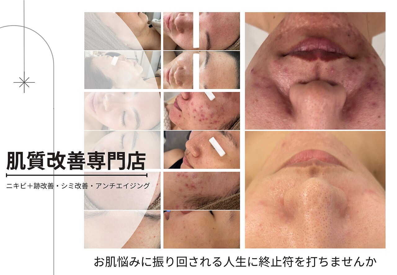 世田谷区で毛穴ケアが人気のエステサロン｜ホットペッパービューティー