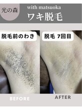 ウィズマツオカ 光の森店/脱毛(7回)効果写真