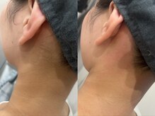 メリア 岡山駅前店(melia)/うなじWAX