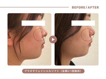 イエス マイサロン(yes My Salon)/プラズマリフトアップ症例