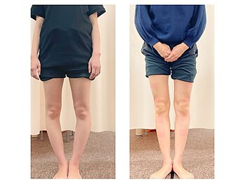 池袋東鍼灸整骨院の写真/憧れの美脚へ！長年のO脚・X脚改善実績多数◎資格有の施術で理想のラインへ♪