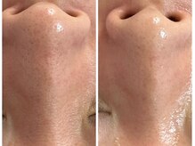 ミロク(369)/Before &After プラズマ