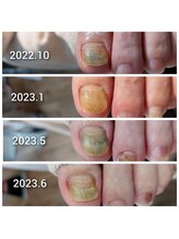 爪切り屋 足楽/爪の変色