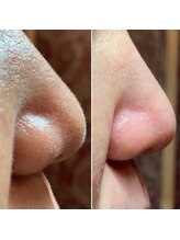 エピシアドットエヌ(epicia.N)/綺麗な鼻はイケメンの証