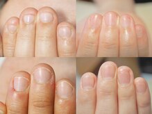 深爪育成お問い合わせお待ちしております♪