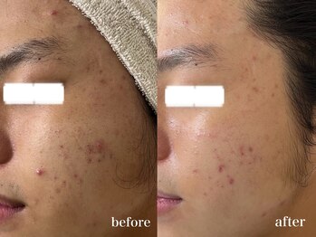 リアルナ(REALUNA)/ニキビ/毛穴詰まり