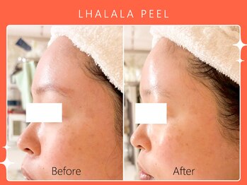 シロカネ 光の森店(SHIROKANE)/韓国肌管理ララピール☆