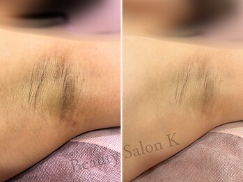 ケイ(K)/《防府》ワキの黒ずみピーリング