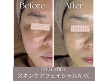 ステラティエ(Stellatier)/シミ/シワ/たるみ/リフトアップ