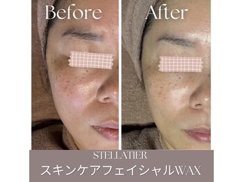 ステラティエ(Stellatier)/シミ/シワ/たるみ/リフトアップ