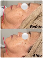 ミセル(MISEL2nd)/シュッとした輪郭に★小顔ケア