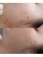 プシュケ(Psyche)/お客様の肌変化