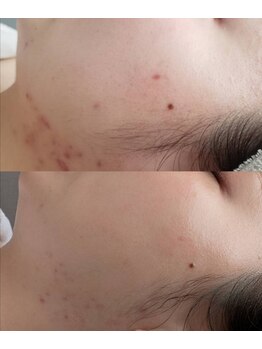 プシュケ(Psyche)/お客様の肌変化