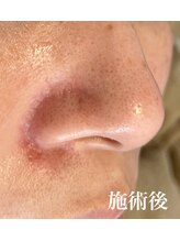ルアナ(Luana)/【毛穴プロコース】施術後