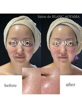 サロン ド ブラン アオヤマ(Salon de BLANC AOYAMA)/BLANC式小顔ソノケアコース