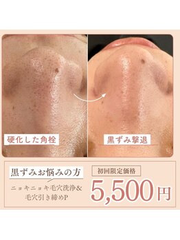 マヴィ 高槻店(MavY.)/毛穴悩みの救世主