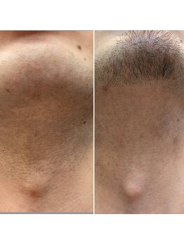 エピシアドットエヌ(epicia.N)/ヒゲデザインもお任せ下さい