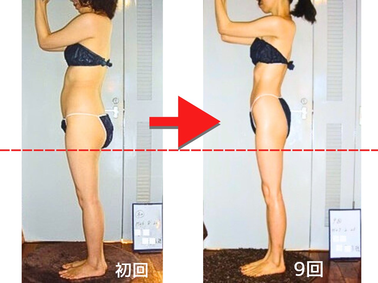 【大幅値下げ】リファインシュール 痩身エステ 劇的ビフォーアフターのご紹介です！ 160㎝／35歳／K様 セルライト