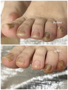 ペディラボ 荻窪店(Pedi Labo)/ネイルケア　症例（２）